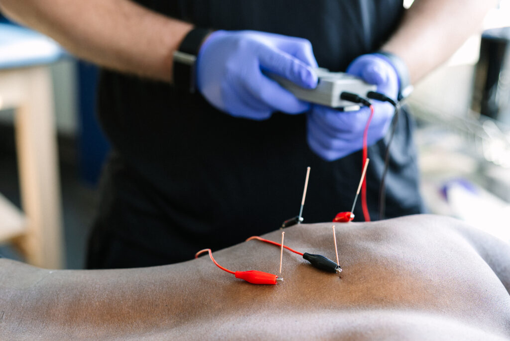 dry needling physical therapy treatment close-up muscle therapy clinical technique